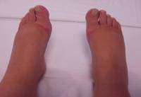 Oedema - before reflexology treatment Reflexology in Oedema BEFORE Treatment