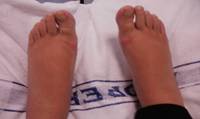 Oedema - after reflexology treatment Reflexology in Oedema AFTER I 200X119