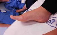 Oedema - after reflexology treatment Reflexology in Oedema AFTER III 200X125